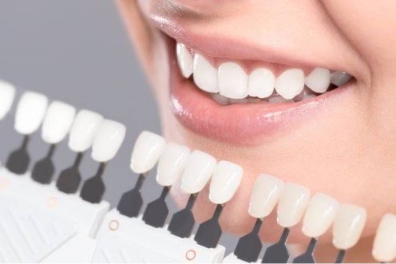 Глубокое фотоотбеливание Smile Lab в Таллинне